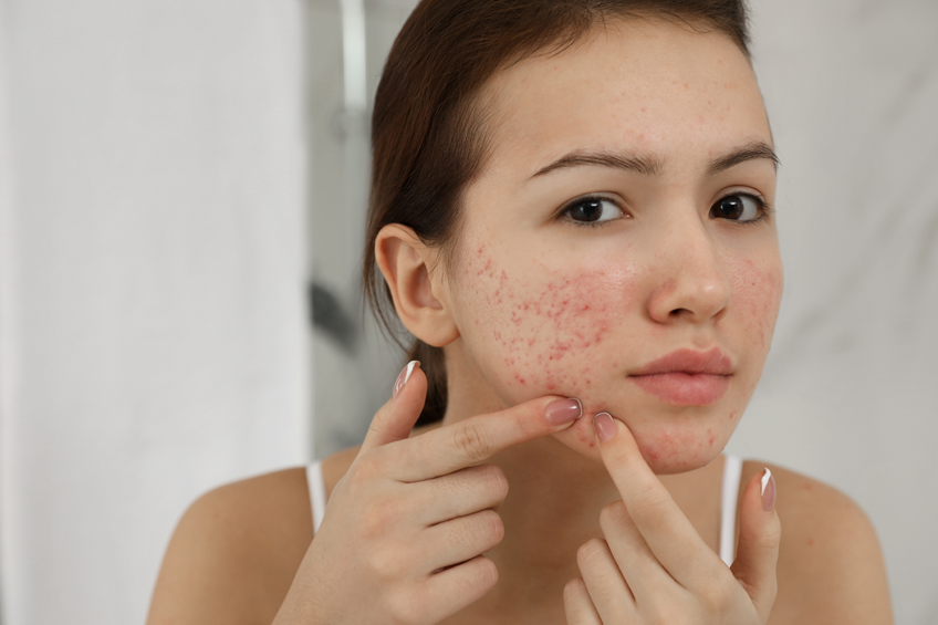 ayurvedic ways to treat acne